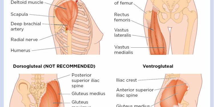 Aplikimi I injeksioneve IM ne muskulin Dorso-Gluteal