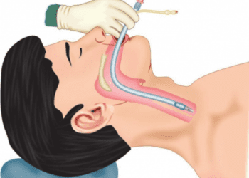 Intubimi Endotrakeal