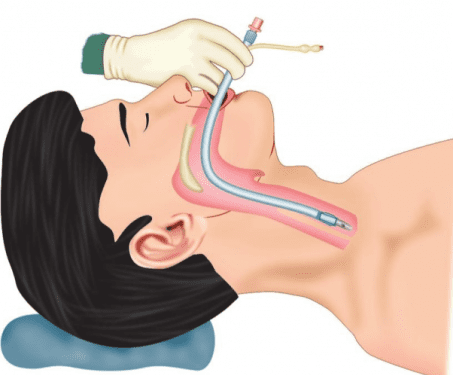 Intubimi Endotrakeal