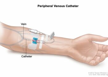 Tromboflebiti, rrezikshmeria dhe si ta parandalojme?