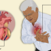 Angina pectoris