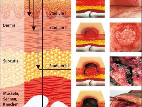 Dekubitueset (Plaget e presionit)