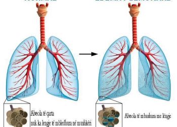Protokolli i kujdesit infermieror ne pacientet me edeme pulmonare.