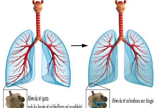 Protokolli i kujdesit infermieror ne pacientet me edeme pulmonare.