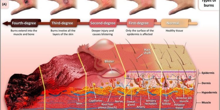 Djegjet, shkallet e djegjes dhe kujdesi shendetesor.